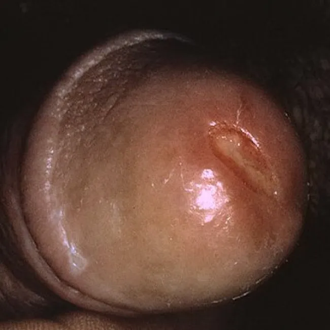 Choroby opis zdjęcia rzeżączka