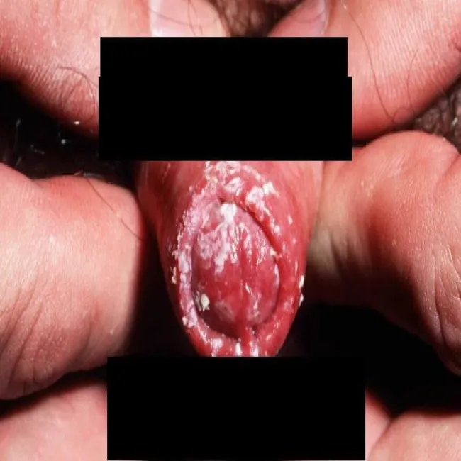 Choroby opis zdjęcia zapalenie napletka