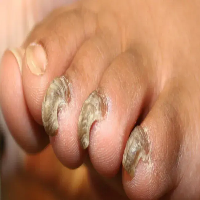Choroby paznokci szponowatość paznokci