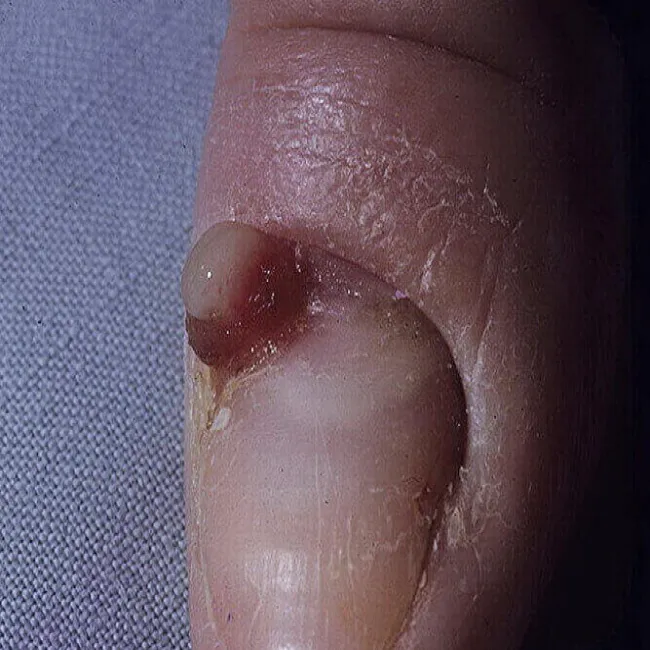 Choroby paznokcia palca u ręki ziarniniak