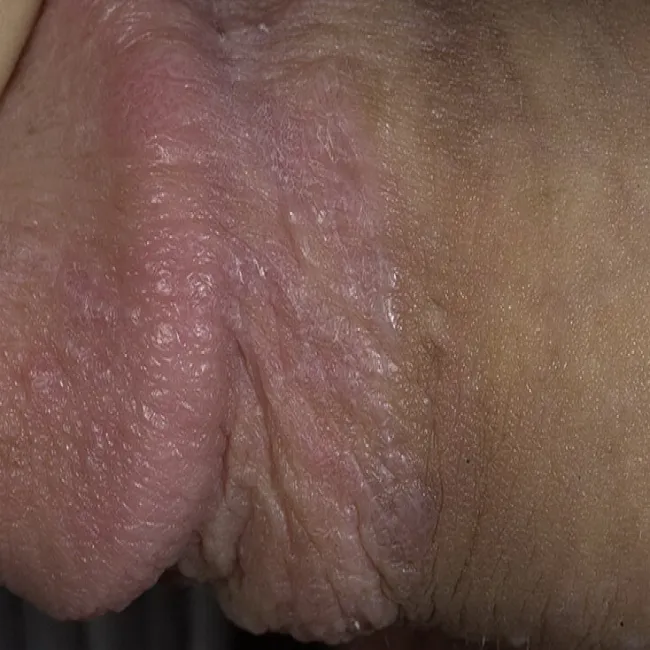 Choroby penisa liszaj płaski