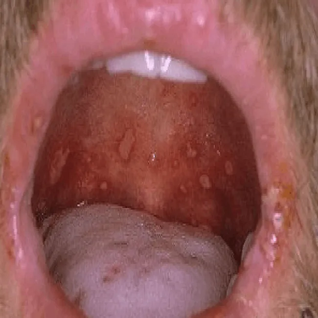 Choroby podniebienia pęcherzyca zwykła