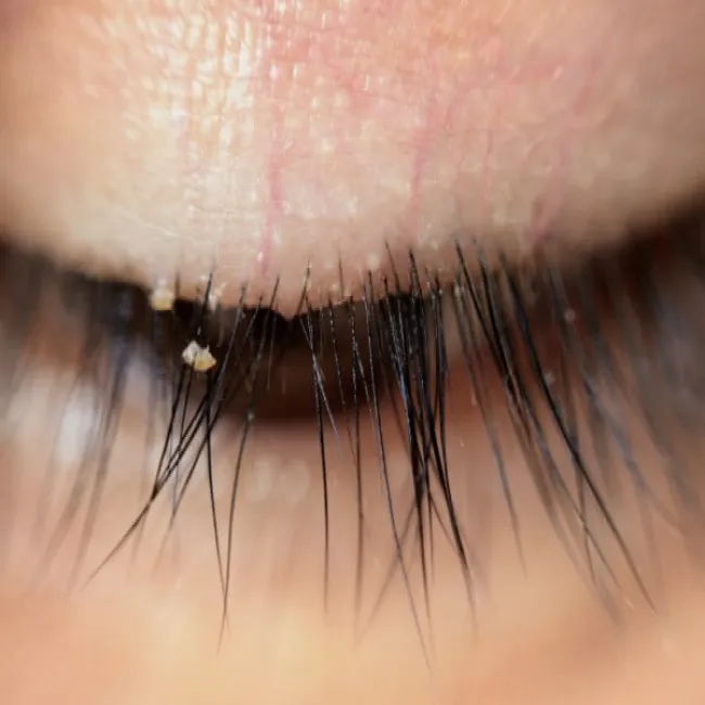 Choroby powiek nużyca