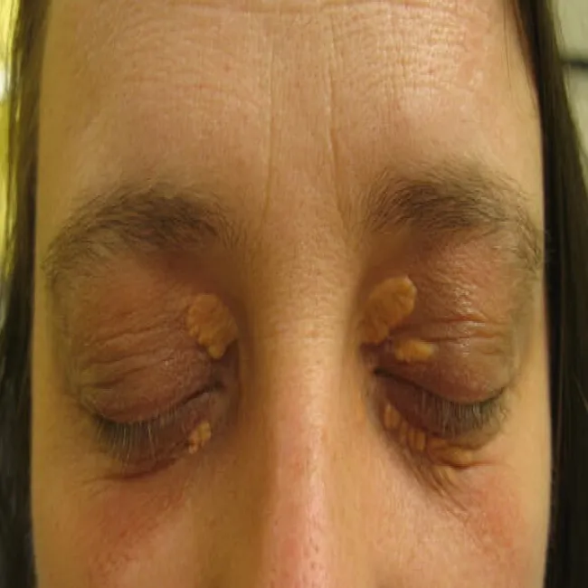 Choroby powiek oczu zdjęcia kępki żółte