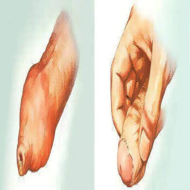 Choroby prącia obrazy stulejka