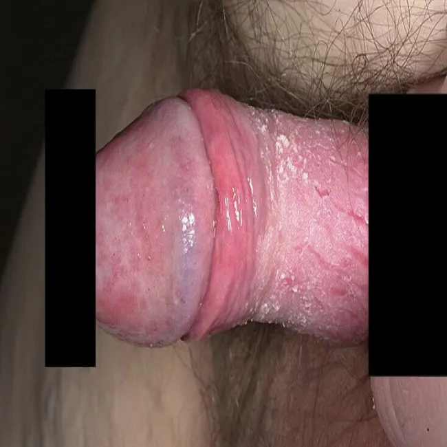 Choroby prącia u dorosłego zapalenie napletka