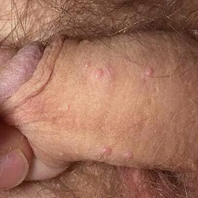 Choroby przenoszone drogą płciową mięczak zakaźny