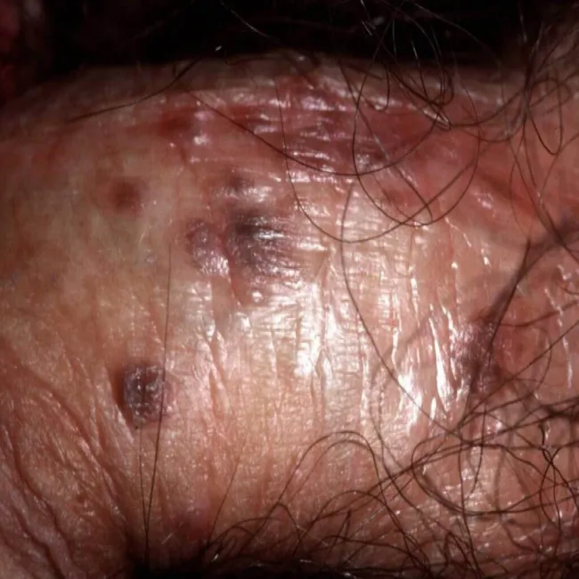 Choroby przenoszone drogą płciową u mężczyzn