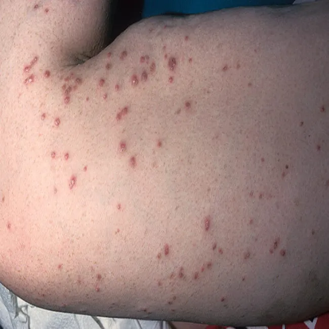 Choroby skórne choroba Kyrle