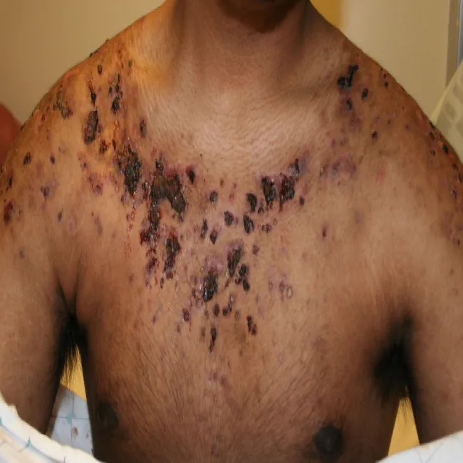 Choroby skórne na klatce piersiowej trądzik piorunujący