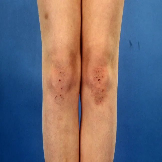 Choroby skórne na nogach choroba Duhringa 