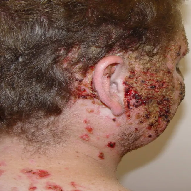 Choroby skórne twarzy pęcherzyca zwykła