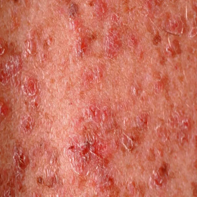 Choroby skóry choroba Dariera