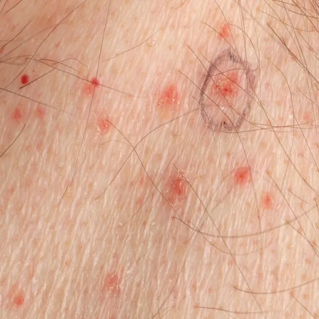 Choroby skóry choroba Grovera