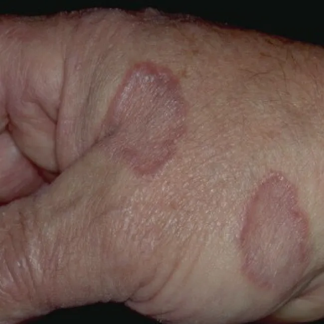 Choroby skóry dłoni obrazy ziarniniak obrączkowaty 