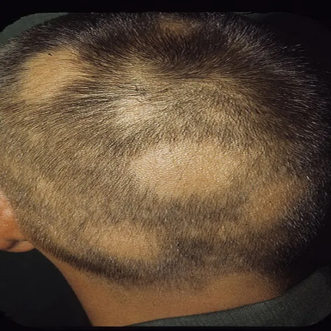 Choroby skóry głowy łysienie plackowate