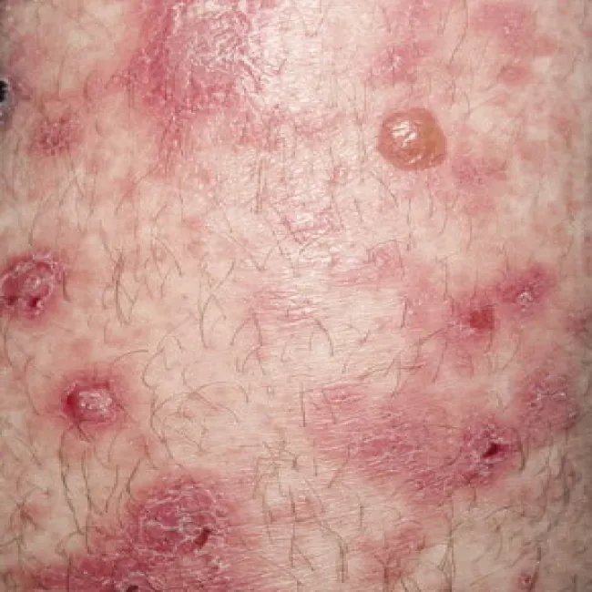 Choroby skóry pęcherzowy liszaj płaski czerwony