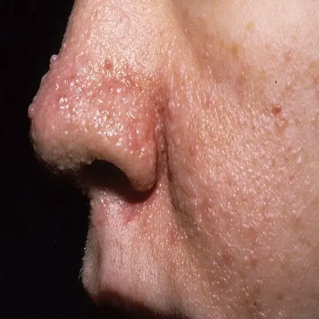 Choroby skóry twarzy i nosa gruczolak łojowy