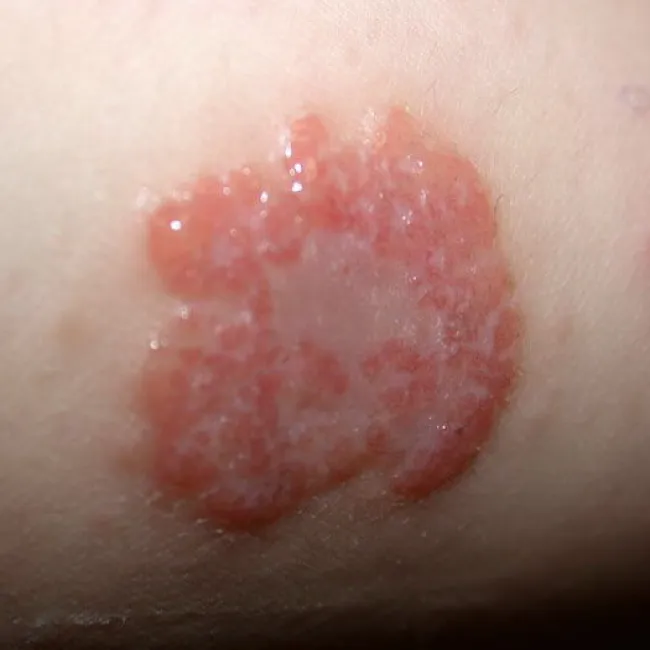 Choroby skóry wyprysk pieniążkowaty