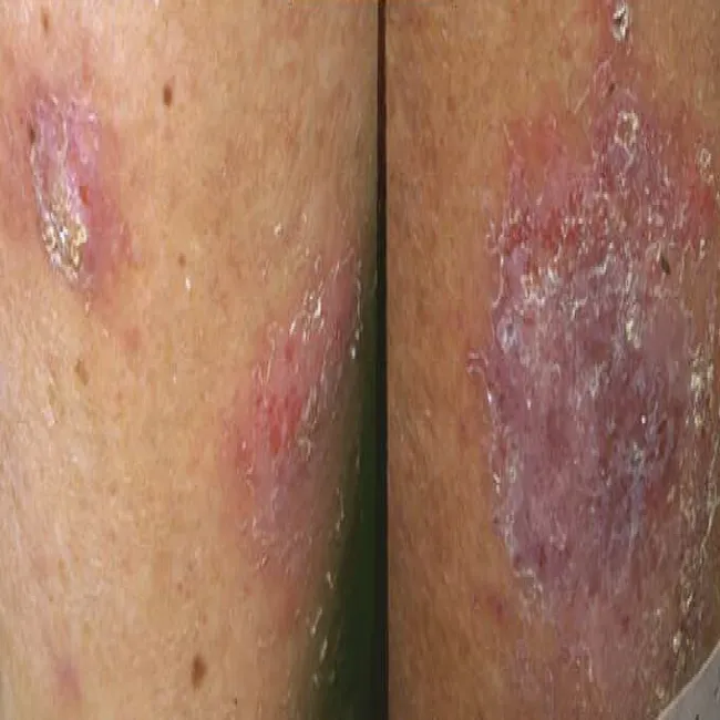 Choroby skóry wyprysk pieniążkowy