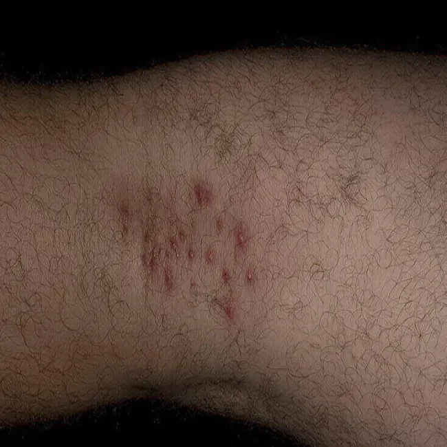 Choroby skóry zapalenie mieszków włosowych