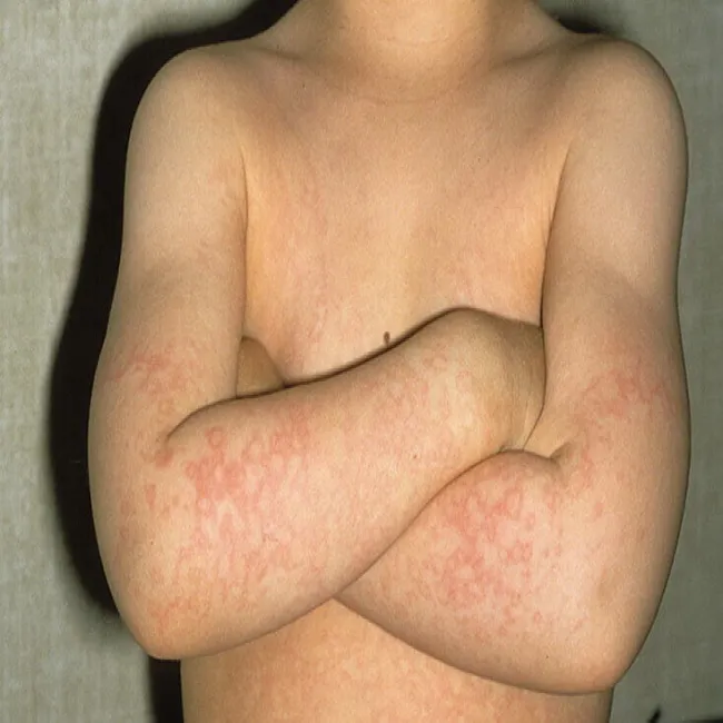 Choroby skóry zdjęcia rumień zakaźny