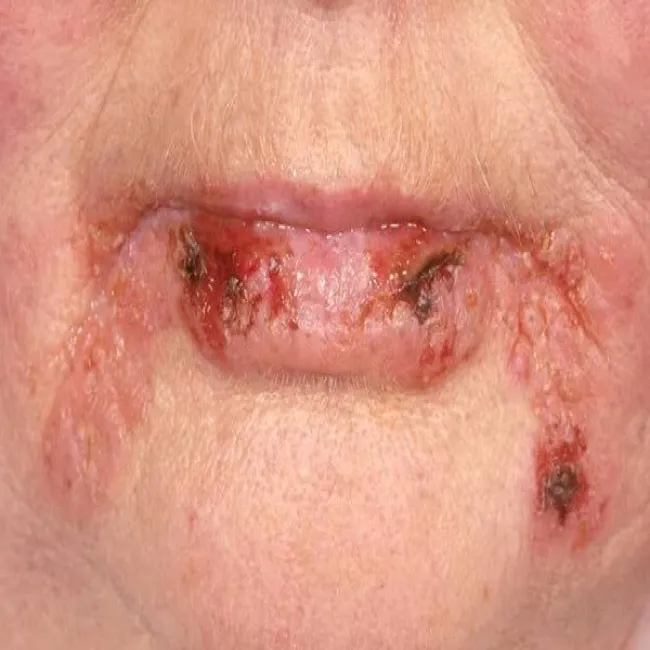 Choroby warg pęcherzyca zwykła