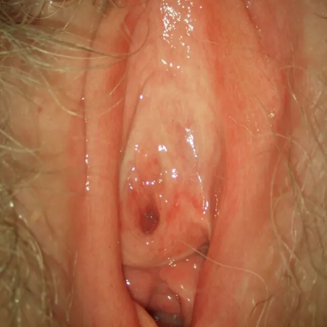 Choroby warg sromowych leukoplakia sromu