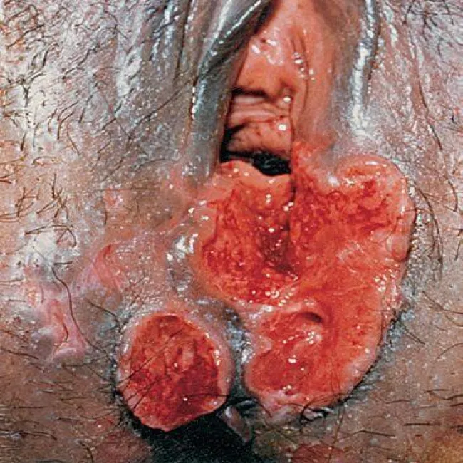 Choroby warg sromowych zdjęcia wrzód miękki