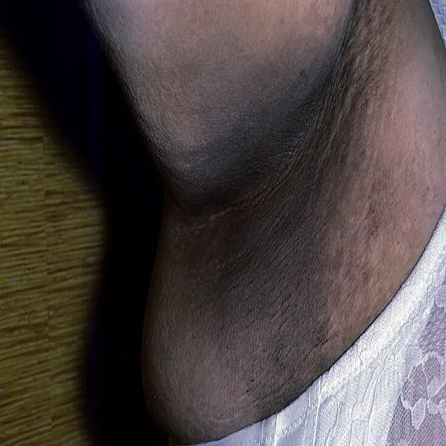 Ciemna skóra pod pachą rogowacenie ciemne 