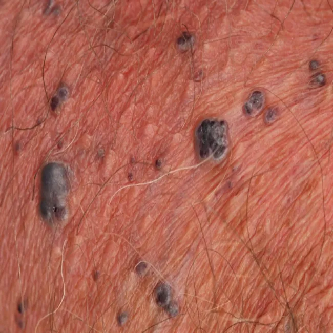 Ciemne guzki na skórze rogowiec krwawy