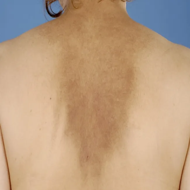 Ciemne plamy na skórze pleców choroba amyloidozy skóry 