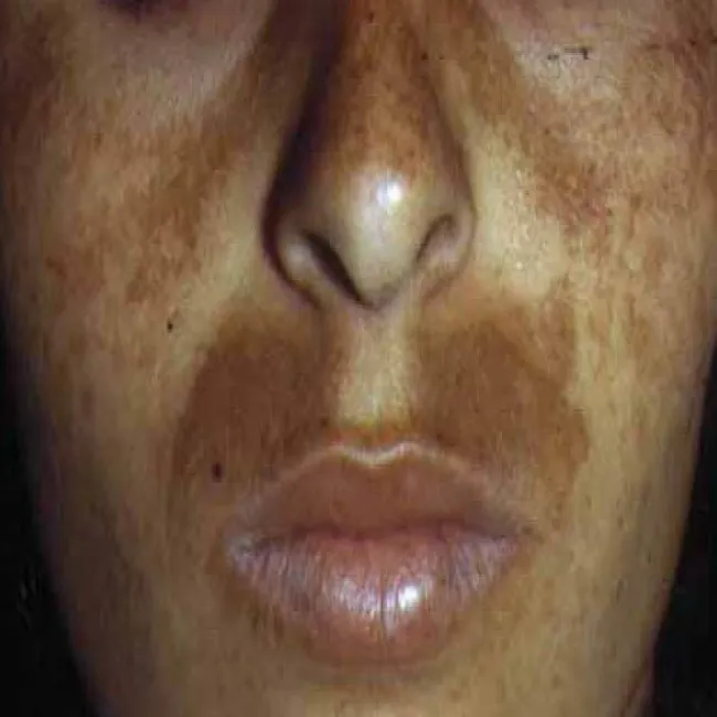 Ciemne plamy na twarzy 