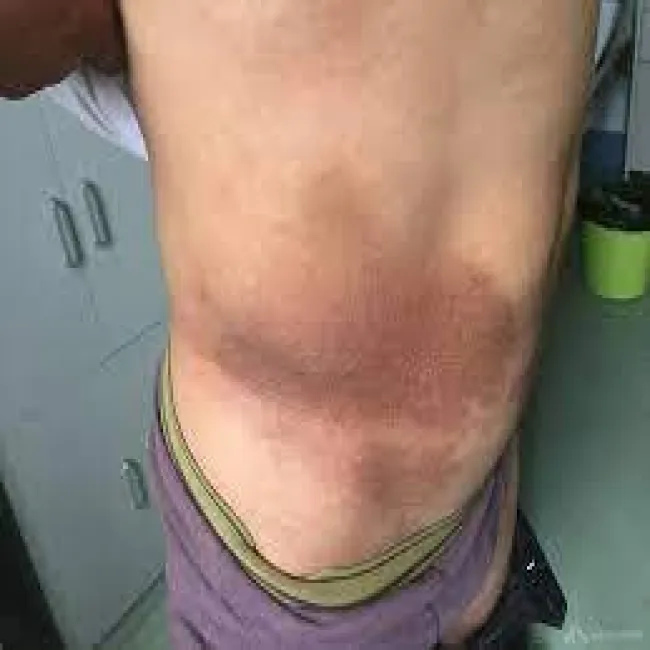 Ciemne plamy na brzuchu choroba rogowacenie ciemne