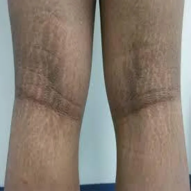 Ciemne plamy na nogach choroba rogowacenie ciemne