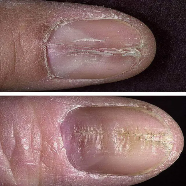 Co to są Linie Beau zdjęcie