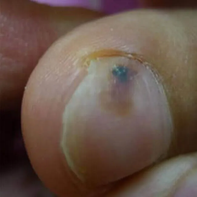 Czarna kropka pod paznokciem