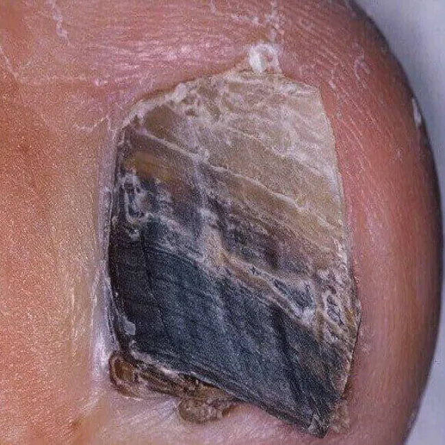 Czarny paznokieć czerniak