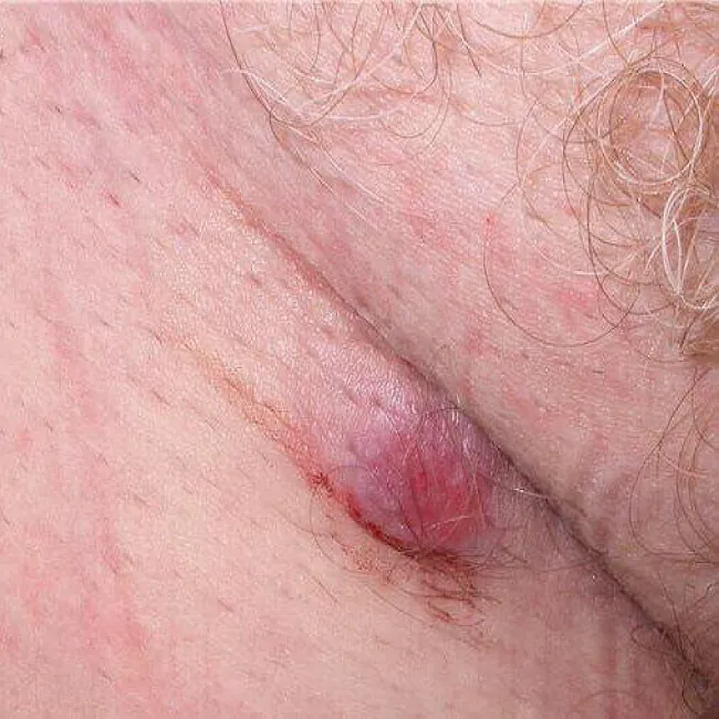 Czerniak miejsc intymnych