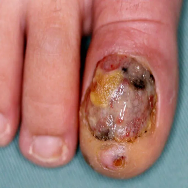 Czerniak na palcu u stopy