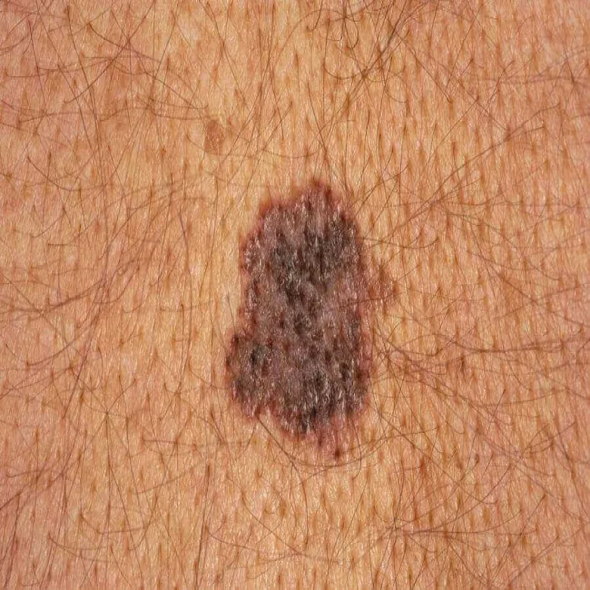 Czerniak na skórze