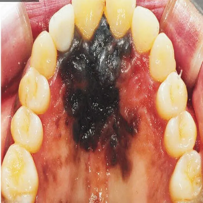 Czerniak podniebienia