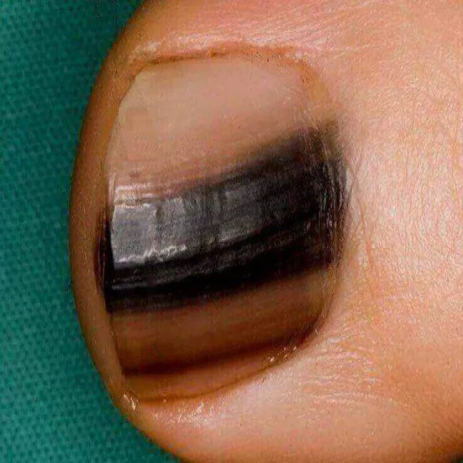 Czerniak podpaznokciowy