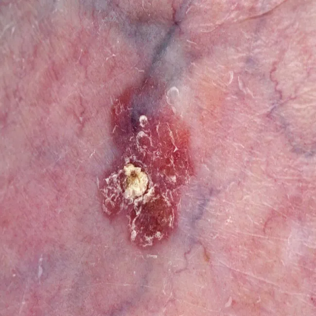 Czerwona plama na skórze choroba rogowacenie słoneczne