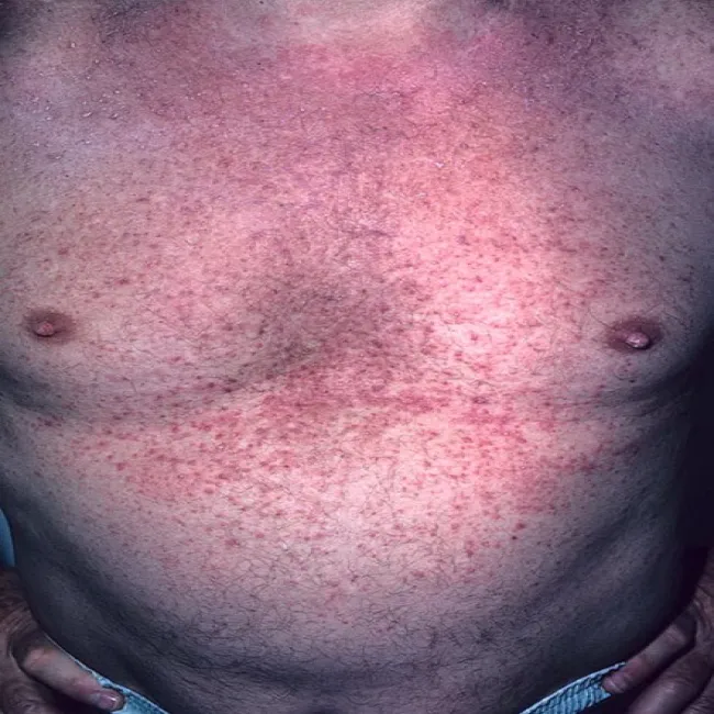Czerwona swędząca wysypka na brzuchu choroba Grovera