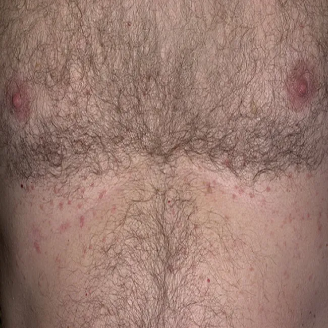 Czerwona wysypka choroba Grovera