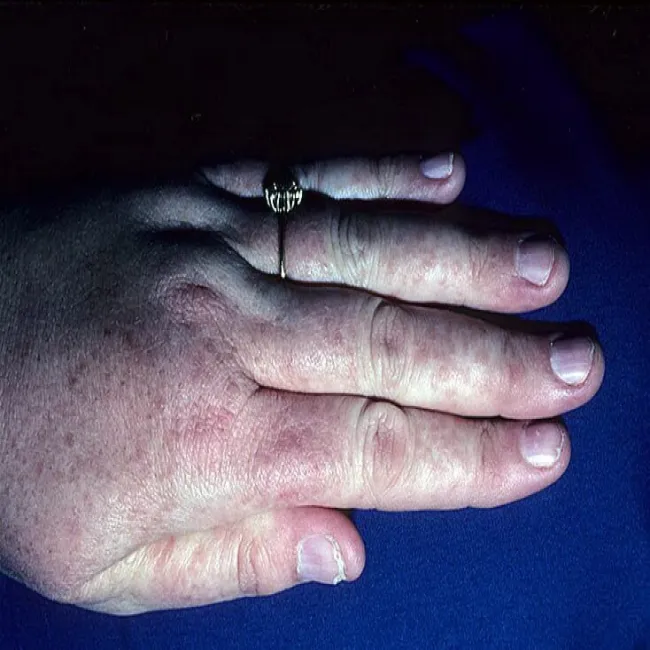 Czerwona wysypka na dłoni choroba Dariera