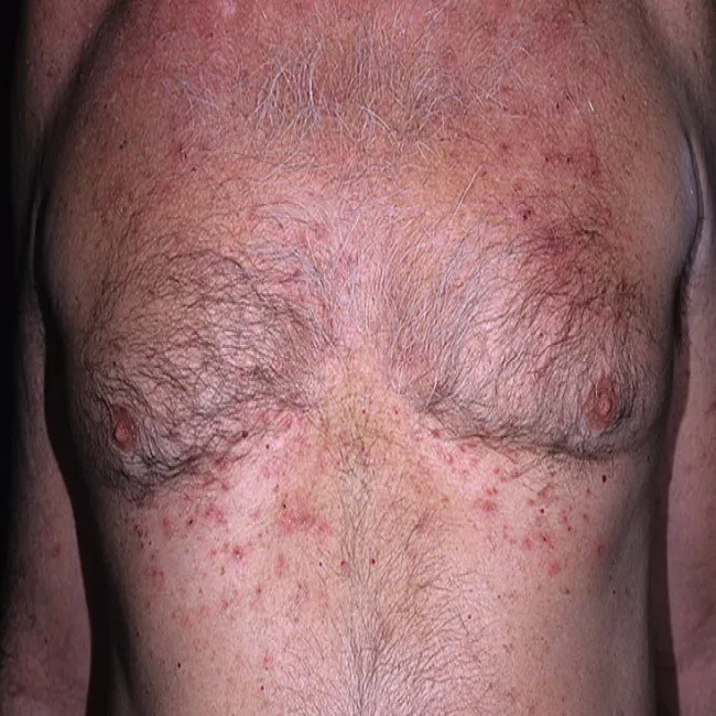 Czerwona wysypka na klatce piersiowej choroba Grovera