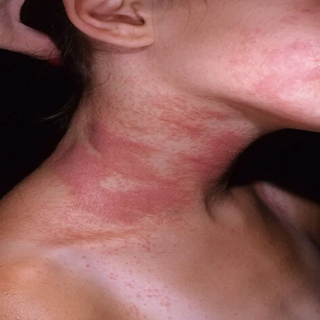 Czerwona wysypka na skórze szyi
