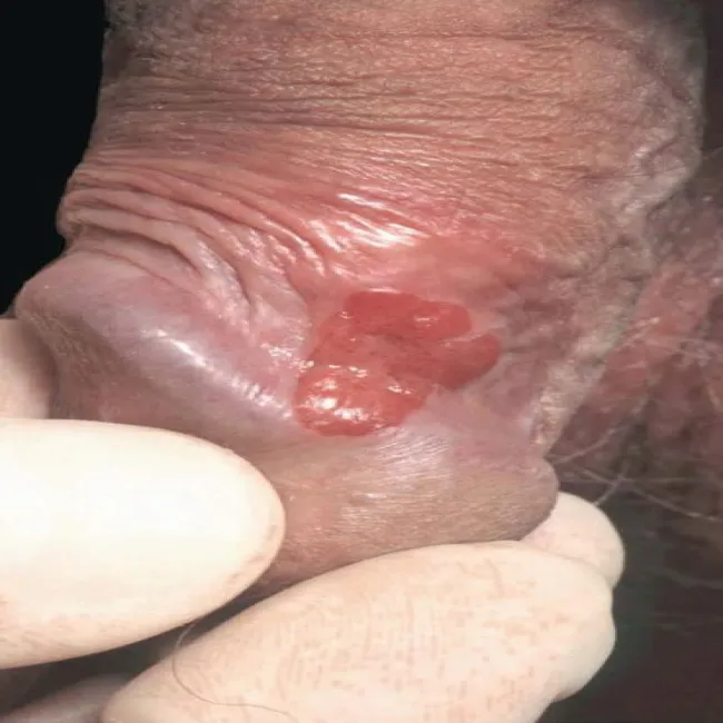 Czerwona zmiana na prąciu erytroplazja Queyrata